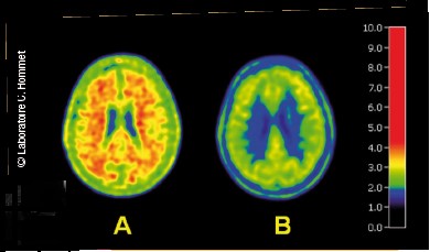 Alzheimer - Exemple d’image obtenue par scintigraphie chez un sujet avec déclin cognitif léger - laboratoire c. hommet