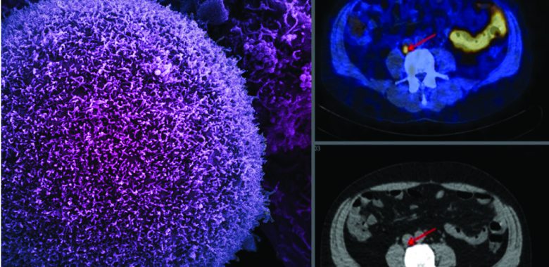 Cancer de la prostate - Dr Rousseau